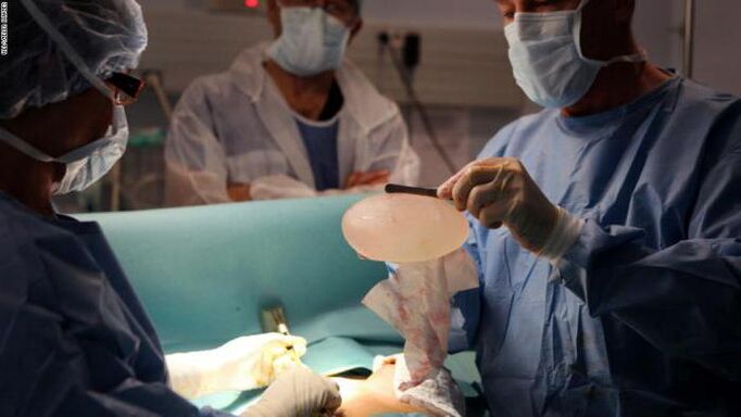 Mga Tampok sa Mammoplasty
