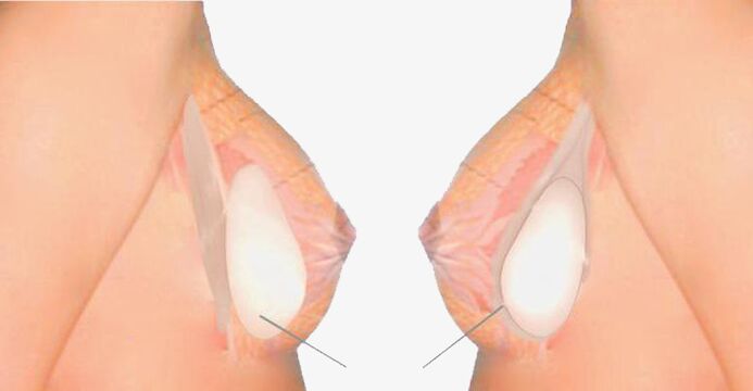 Unsa ang Mammoplasty