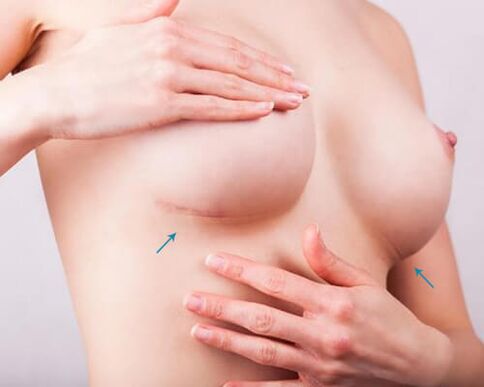 Pagpadako sa dughan nga adunay mga implants