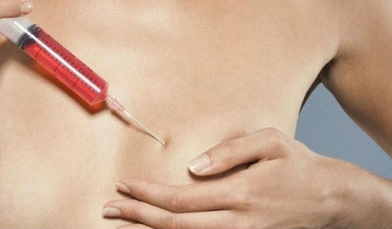 Pagdugang sa suso nga adunay hyaluronic acid injection